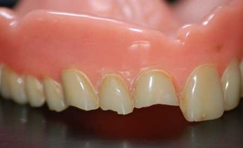Dents pour dentier .Réparer un appareil dentaire ou rajouter une dent